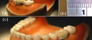 Vers des dents connectées? Bientôt, nos dents intégreront la technologie Bluetooth